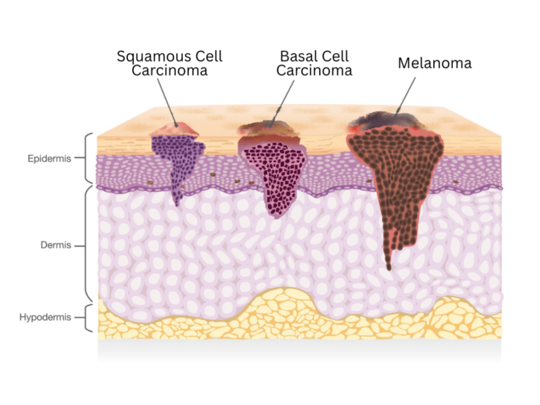 Basal Cell Carcinoma vs. Squamous Cell Carcinoma: What’s the Difference?