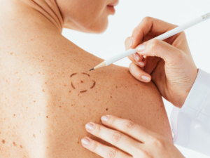 Debunking the 5 Most Common Skin Cancer Myths